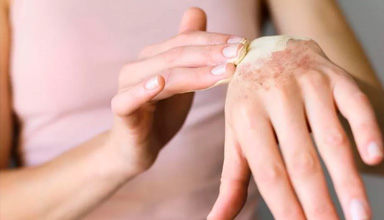 Skin and Nail Infection Treatment