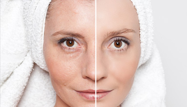 Dermabrasion (Skin Resurfacing)