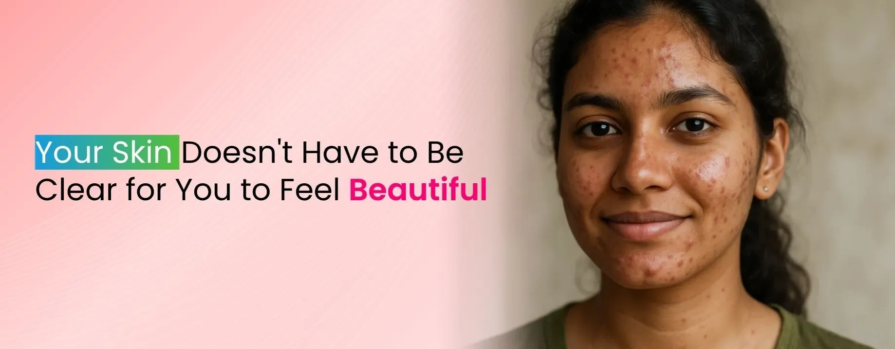 Your Skin Doesn't Have to Be Clear for You to Feel Beautiful