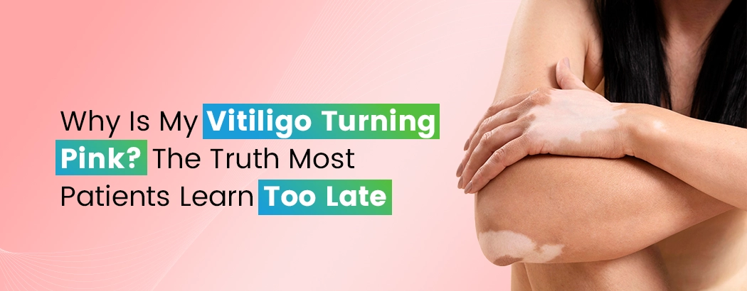 Why Is My Vitiligo Turning Pink? The Truth Most Patients Learn Too Late